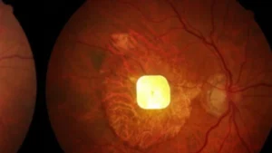implant prima oeil